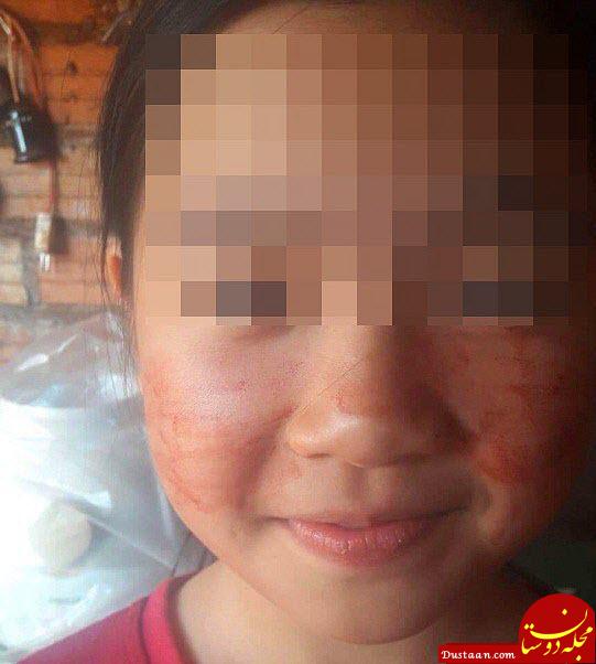 www.dustaan.com این دختر 11 ساله خون عرق می کند! +تصاویر