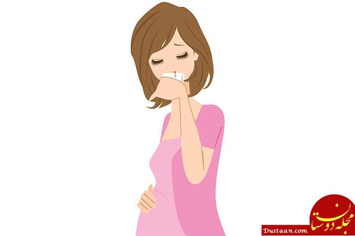 http://www.iranve.com/wp-content/uploads/2015/04/nose-bleeding-during-pregnancy.jpg