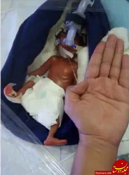 www.dustaan.com عکس های شگفت انگیز از نوزادی که در چهار ماهگی به دنیا آمد!