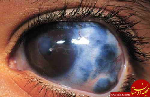 https://altinmed.com/wp-content/uploads/2018/06/glaucoma-1.jpg