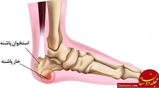 https://www.drhakim-pt.com/uploads/articles/backup/55cc1de1d64cb23cb00a29a3beb4659f-Heel_spur.jpg