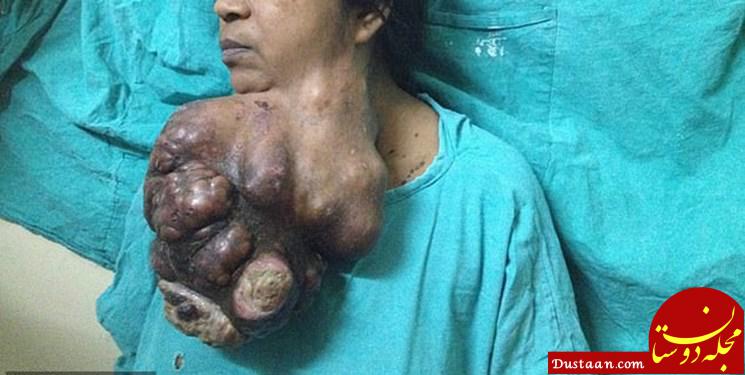 تومور ۵ کیلویی در چانه زن هندی +تصاویر