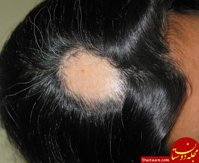 https://www.hairloss.ir/wp-content/uploads/2017/09/rizesh-sekeii.jpg
