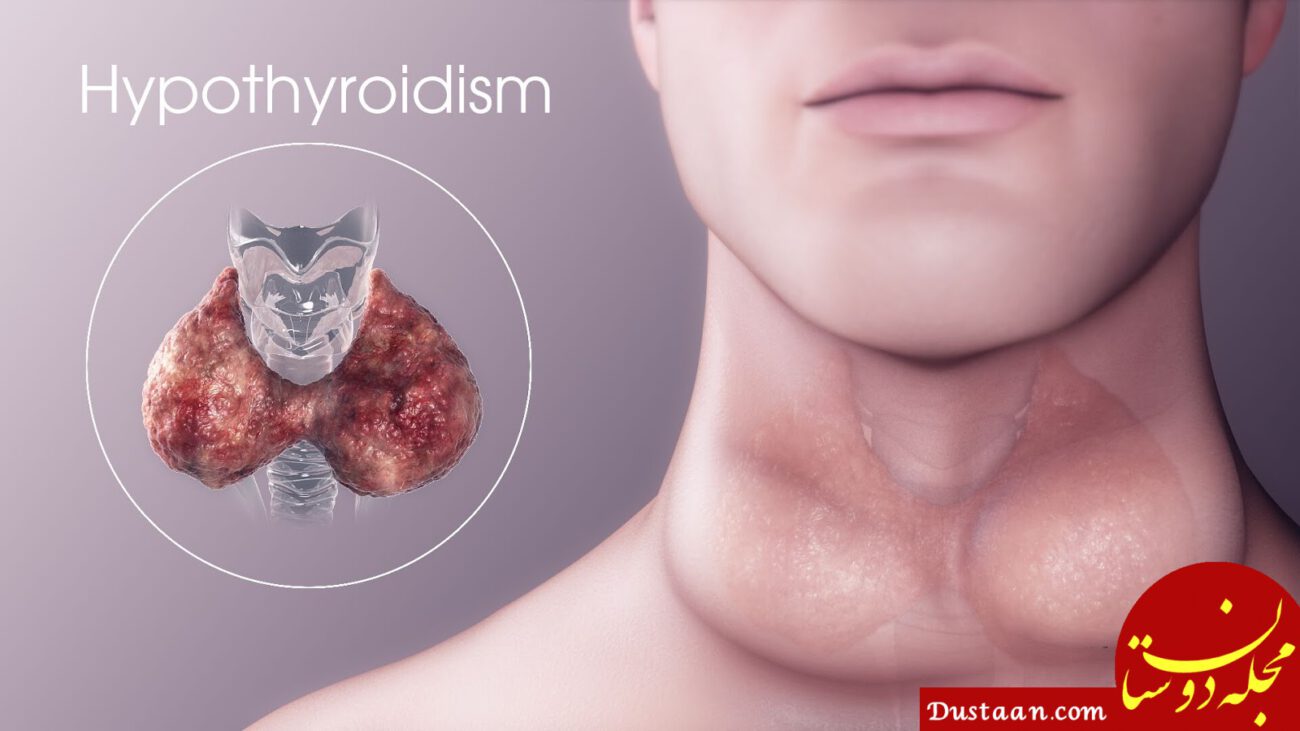 https://www.blog.drvikram.com/wp-content/uploads/2019/01/What-is-Hypothyroidism.jpeg