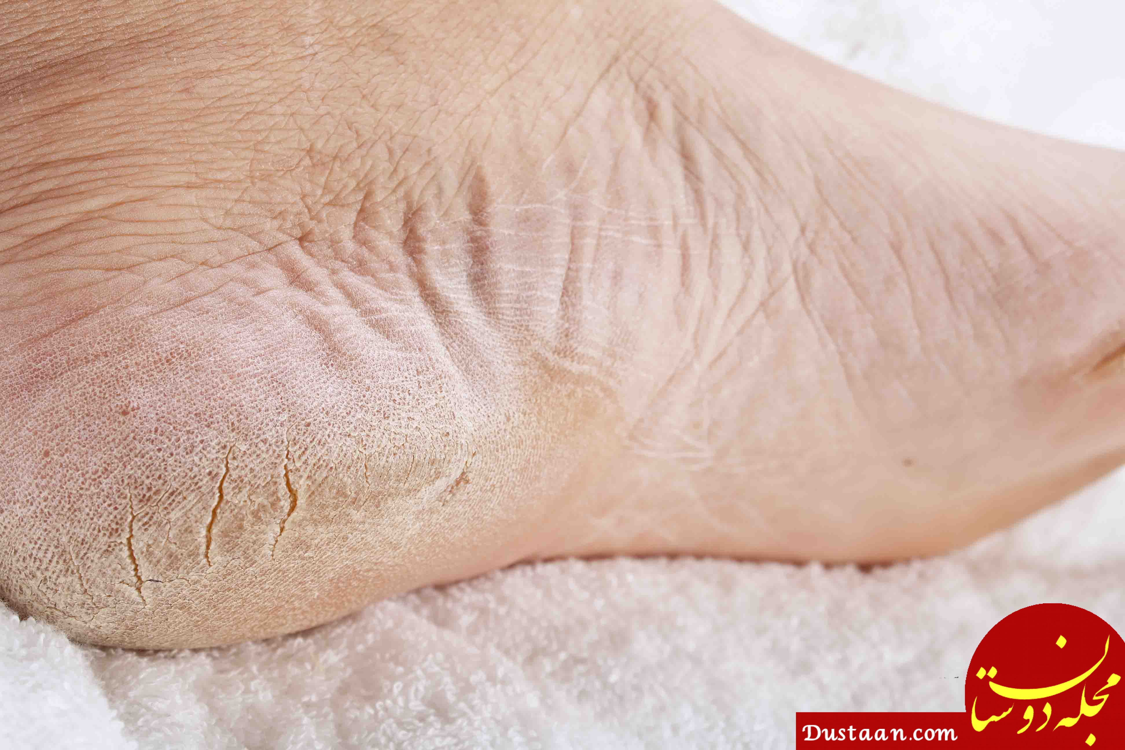 www.dustaan.com-درمان خانگی ترک پاشنه پا و ریش ریش شدن آن با کمک طب سنتی
