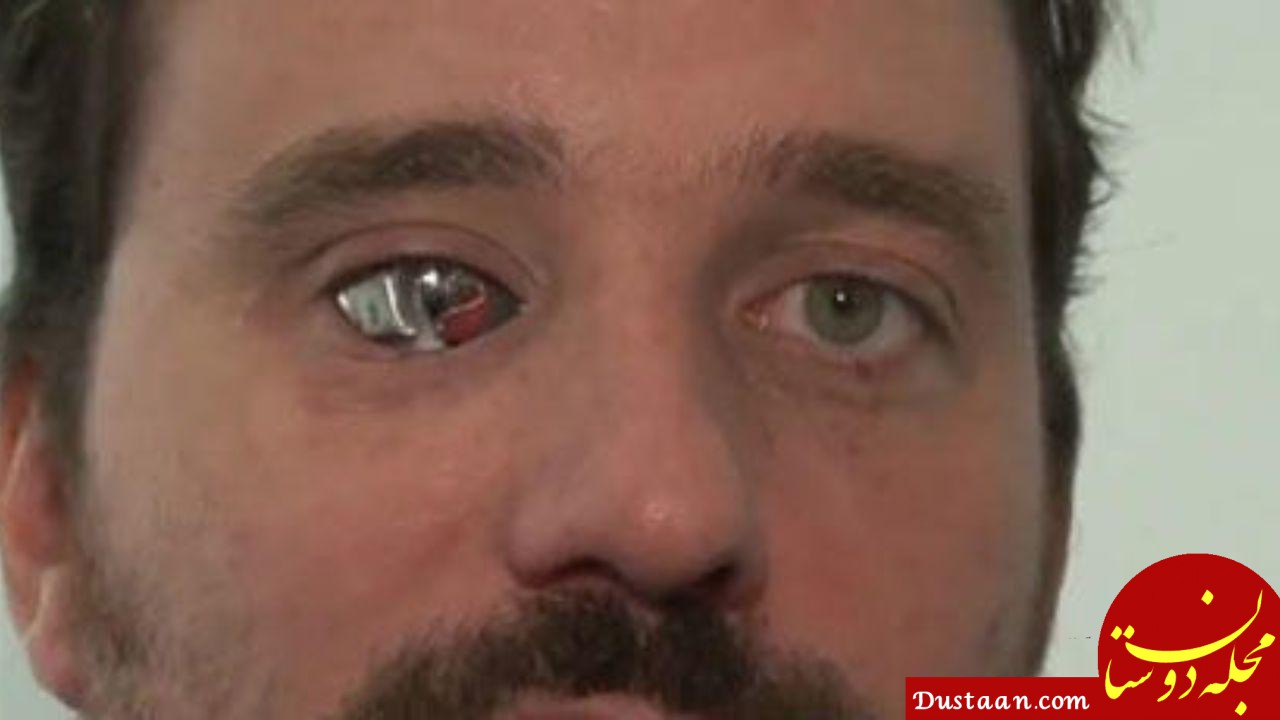 مرد کانادایی دوربین را جایگزین چشم نابینای خود کرد!