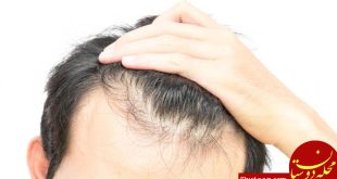 6 علت اصلی ریزش مو را بشناسید