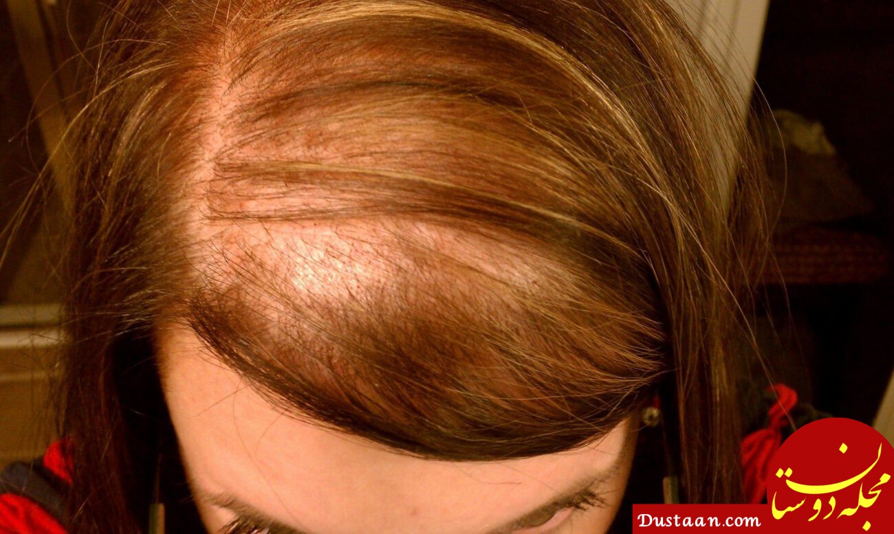علت نازک شدن و ریزش موی زنان چیست و چه درمان هایی دارد؟