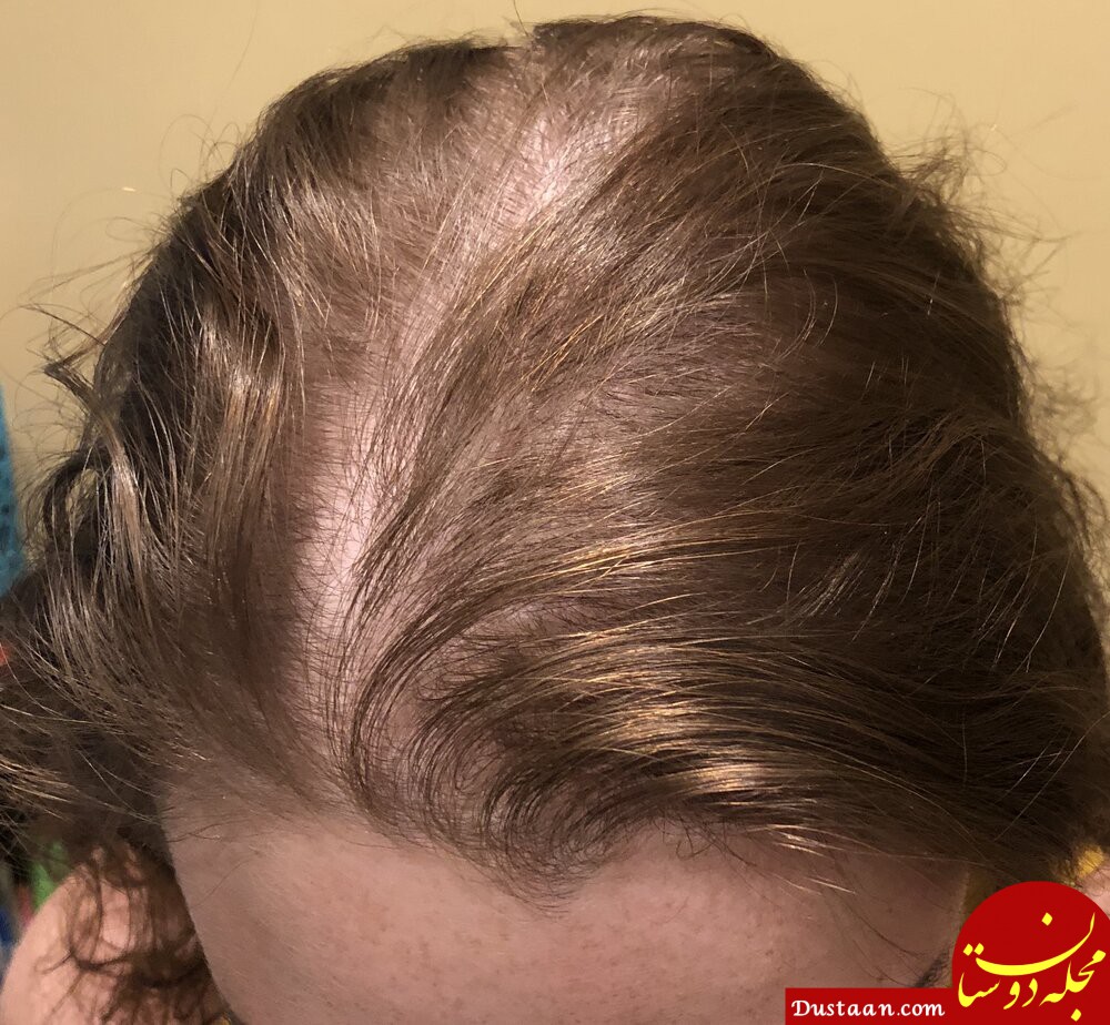 علت نازک شدن و ریزش موی زنان چیست و چه درمان هایی دارد؟