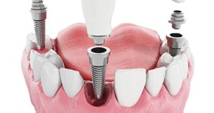 جایگزین‌های ایمپلنت دندان