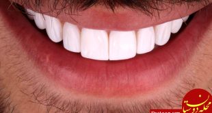 روش جدید برای درمان پیوره دندان