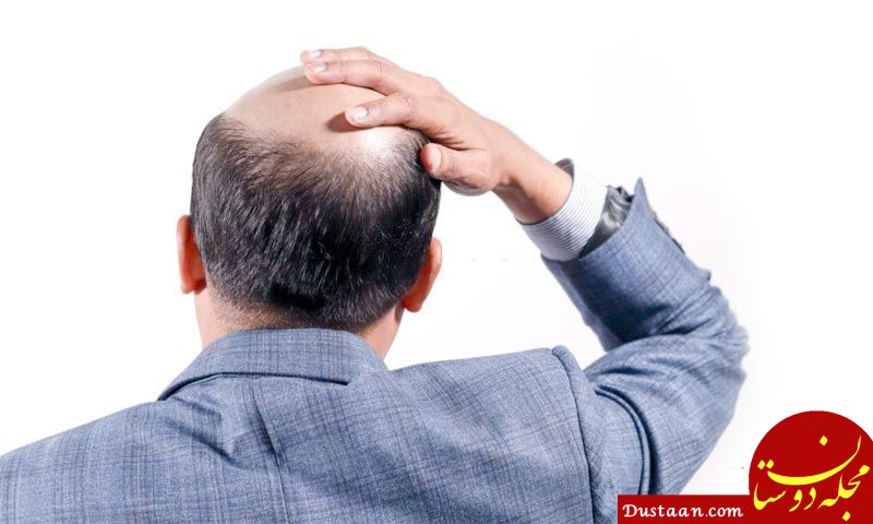 جدیدترین روش کاشت مو کدام است ؟ DHI یا Micro FIT