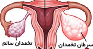 نشانه های سرطان تخمدان چیست؟