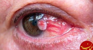 نشانه های ابتلا به سرطان چشم