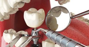مراحل ایمپلنت دندان ، مزایا و عوارض آن